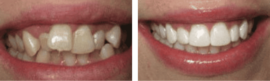 6-months-braces before after