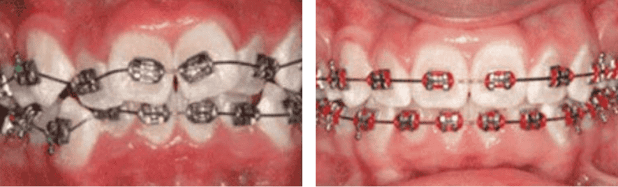 Kids Braces before after