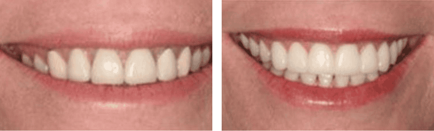 Veneers before after