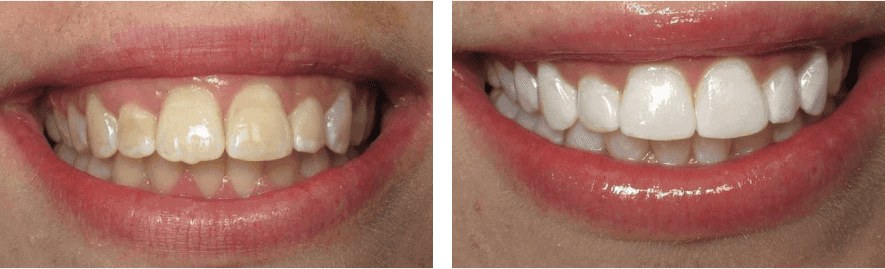 Whitening Before and After